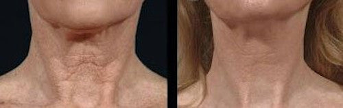 Bring It Up Instant Neck Lift Adhesive, One Pack of 30 Day Supply