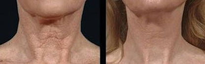 Bring It Up Instant Neck Lift Adhesive, One Pack of 30 Day Supply