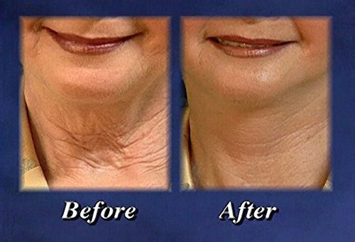 Bring It Up Instant Neck Lift Adhesive, One Pack of 30 Day Supply