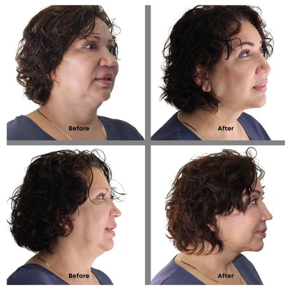 Bring It Up Instant Neck Lift Adhesive, One Pack of 30 Day Supply